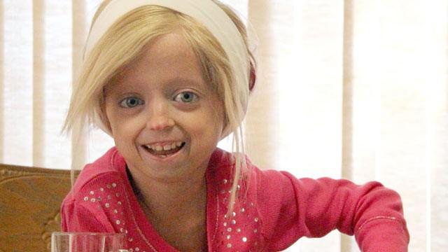 progeria infantil
