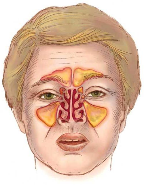 síntomas del tratamiento sinusitis